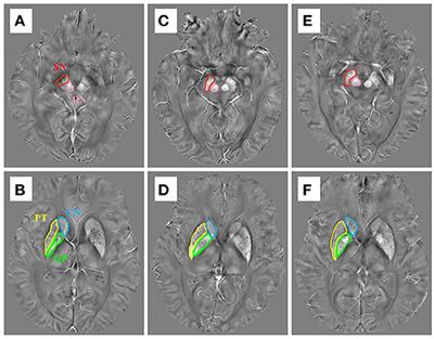 Time-Specific Pattern of Iron Deposition in Different Regions in Parkinson's Disease Measured by Quantitative Susceptibility Mapping
